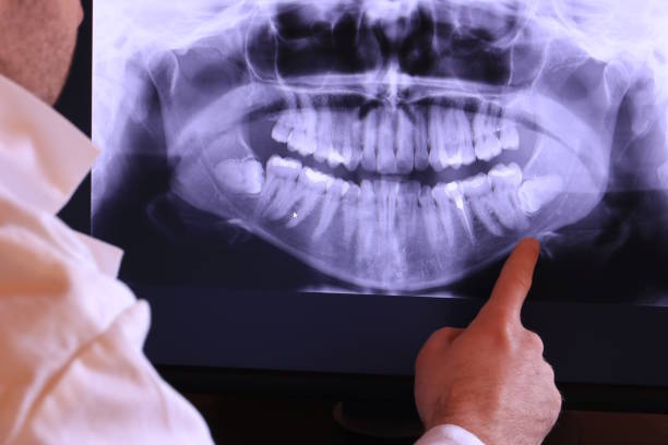 Best Emergency Wisdom Tooth Extraction in Deer Park, TX