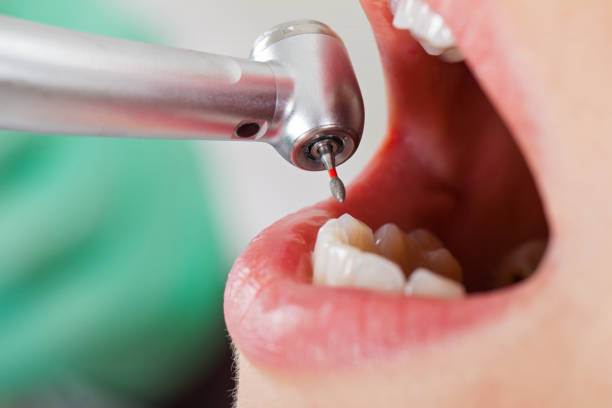 Best Knocked-Out Tooth (Avulsed Tooth) Treatment in Deer Park, TX